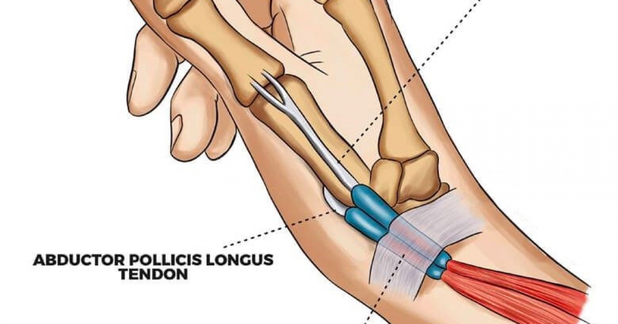 Лигаментит сухожилий. Стенозирующий лигаментит 1 пальца кисти. Стенозирующий лигаментит рентген. Стенозирующий лигаментит. Лигаментит 1-го пальца кисти.
