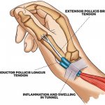 Top Five Tips for Dealing With Gamer's Thumb